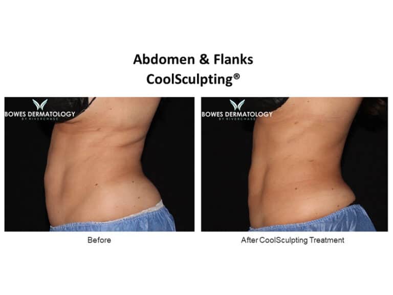 Coolsculpting Before And After Photos | CoolSlim